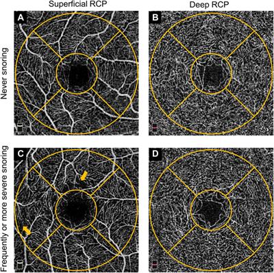 Association of self-reported snoring with decreased retinal thickness and vessel density